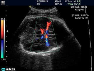 Evalúa el flujo sanguíneo en los vasos fetales y placentarios, permitiendo detectar alteraciones en la circulación que puedan afectar el bienestar del feto.